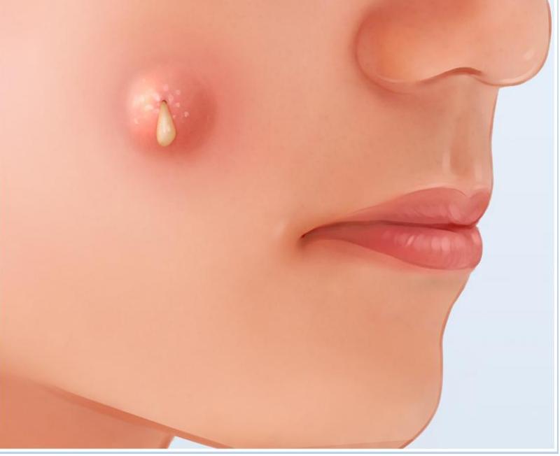 揭秘皮脂腺囊肿：别让“小疙瘩”成大麻烦