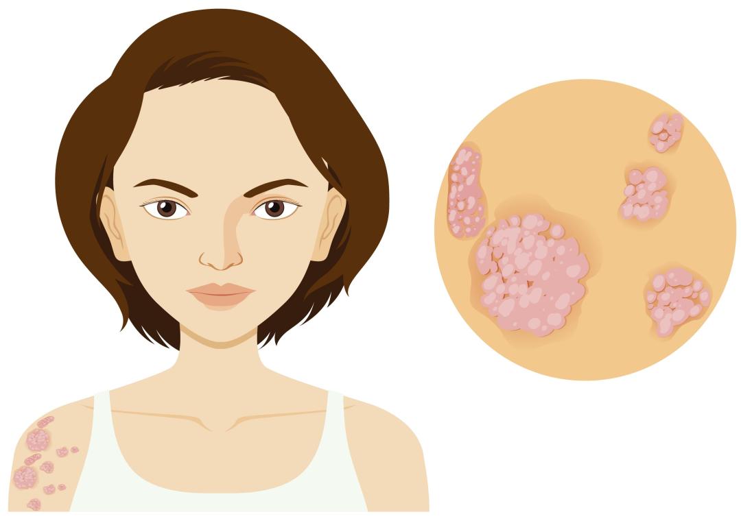 秋冬银屑病“冒头”？科学应对筑牢健康防线
